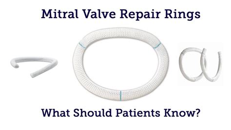 Mitral Valve Repair Annuloplasty Rings Surgeon Qanda With Dr Steve