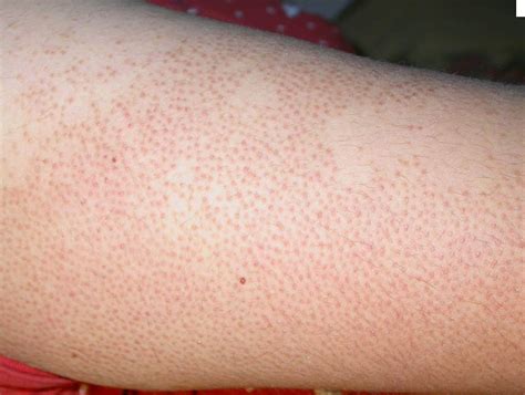 Little Bumps On Upper Arms Dorothee Padraig South West Skin Health Care