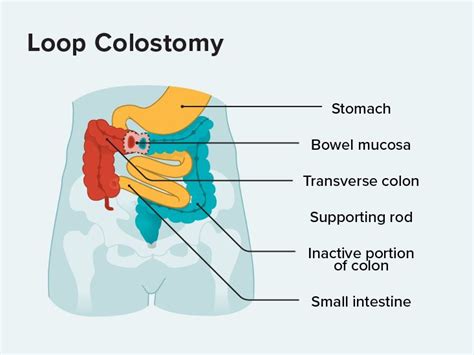 Loop Colostomy What You Should Know