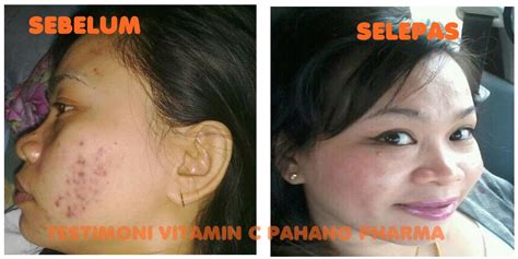 1000mg vitamin c = 20 biji buah oren sunquick. HUJUNG JARI: VITAMIN C 1000MG PAHANG PHARMA