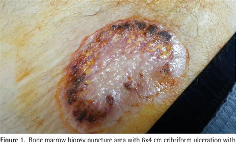 Figure 1 From Bullous Pyoderma Gangrenosum In A Patient With Acute
