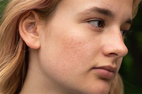 What Are The Stages Of Rosacea Summitmd Dermatology