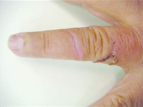 Cutaneous Larva Migrans After 3 Weeks Follow Up Linear And