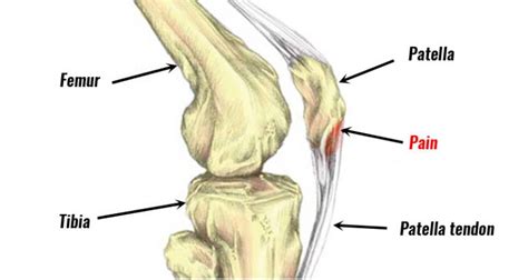 Patellar Tendonitis Jumpers Knee Symptoms Causes And Treatment