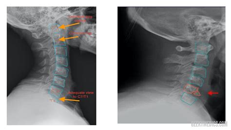 Cervical Spine X Ray Tewsright