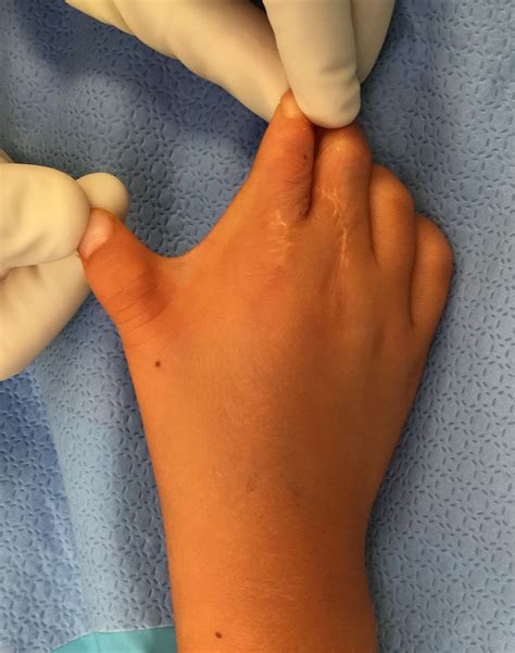 Skin Contracture And Z Plasty Correction Congenital Hand And Arm
