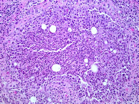 Pathology Outlines Cystic Neutrophilic Granulomatous Mastitis