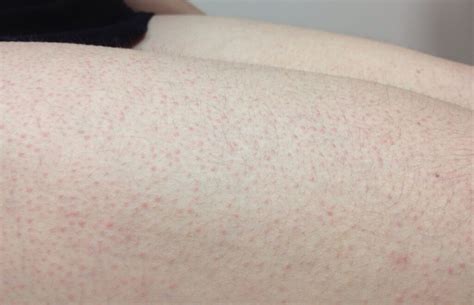 Red Painful Rash Bumps On Thighs Causes And Treatments American Celiac