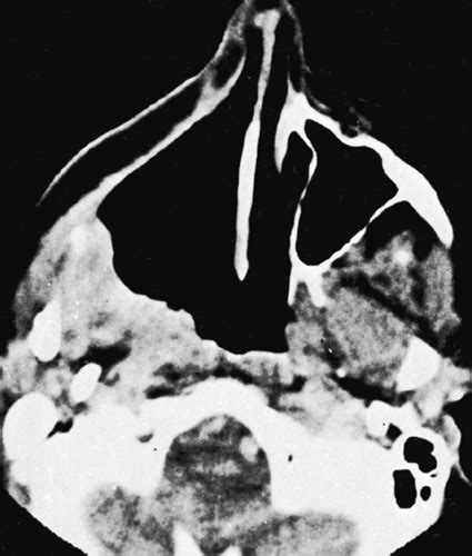 The Paranasal Sinuses Radiology Key