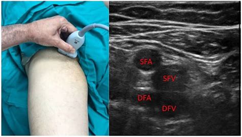 Rapid Femoral Vein Assessment Rafeva A Systematic Protocol For
