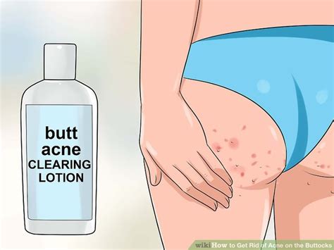 What are those, how can i get rid of those? 3 Ways to Get Rid of Acne on the Buttocks - wikiHow