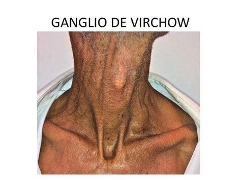 Ganglio Virchow Pdf