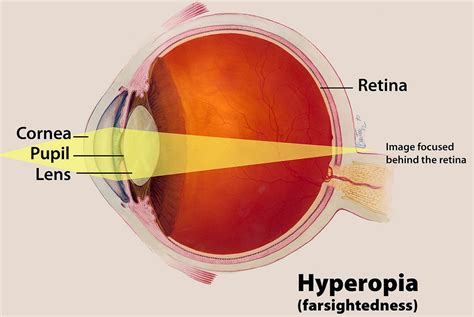 Hyperopia Farsighted Vision Causes Symptoms Diagnosis And Treatment
