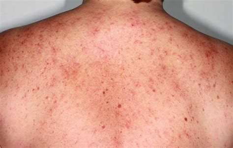 Spider Angioma Causes Symptoms Diagnosis And Spider Angioma Treatment