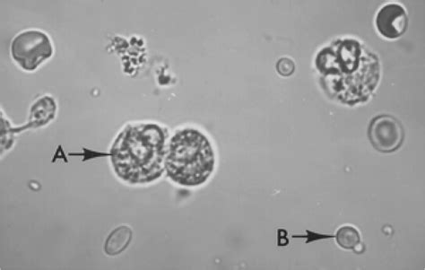 Epithelium cells tubular (renal) epithelium cells are absent normally in the urine. kidney 1 A - Medicine 1 with Calabrese at Oklahoma State ...