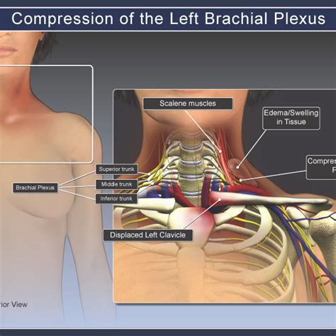 Compression Of The Left Brachial Plexus Trialexhibits Inc