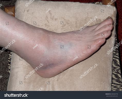 Bruised Swollen Sprained Ankle ภาพสต็อก 585904778 Shutterstock