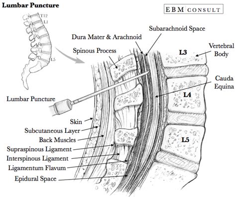 Procedure How To Do A Lumbar Puncture Lumbar Puncture