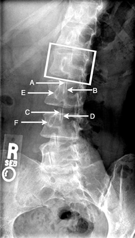 Right Posterior Oblique Radiograph Of The Lumbar Spine The Figure