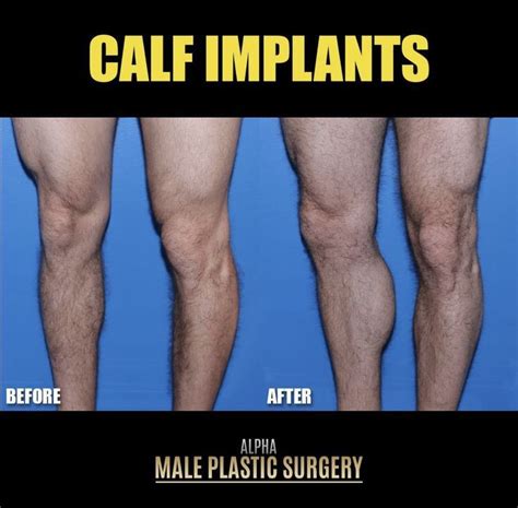 Before And After Male Plastic Surgery Implants Calves