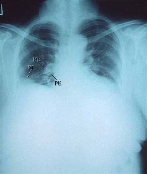 Pulmonary Embolism Chest X Ray