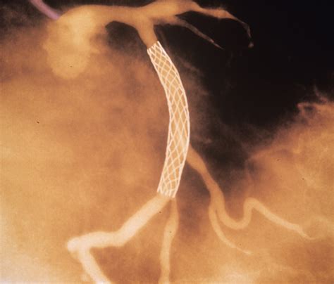 ‘unbelievable Heart Stents Fail To Ease Chest Pain The New York Times