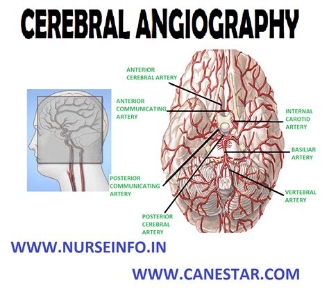 Cerebral Angiography Nurseinfo