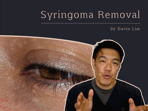 Syringoma Removal Cutis Dermatology
