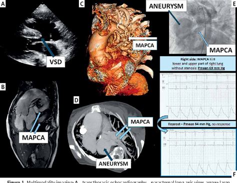 Figure From An Overview Of Pulmonary Atresia And Major Aortopulmonary