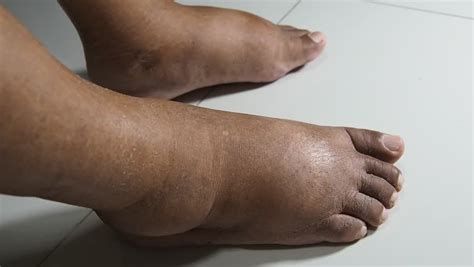 What Can Cause Swollen Feet Images And Photos Finder