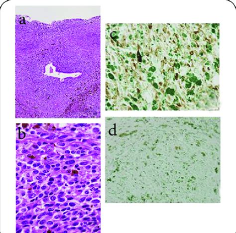 Histopathology Of Malignant Melanoma Of The Urethra A Melanoma Cells