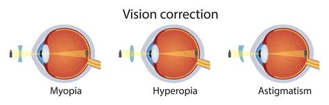 Correction Of Various Eye Vision Disorders By Lens Hyperopia Myopia