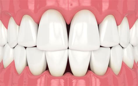 Treatment Approaches For Dental Black Triangles Dentistry Of Miami