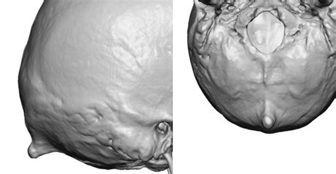 Plastic Surgery Case Study The Male Occipital Knob Skull Reduction