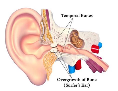 Otex ear drops are used to help remove hardened wax from the ear canal. Surfers Ear — Tui Ear Clinic