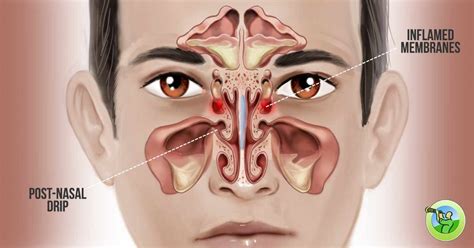 Another Turn For Stuffy Nose Is Nasal Congestion Often This Is A