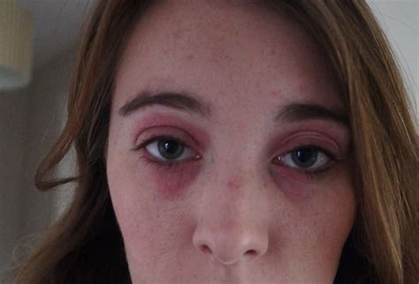 Red Patches On Eyelids Pictures Photos