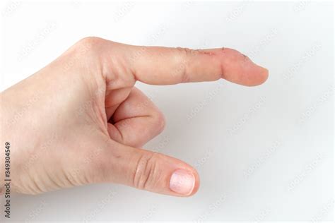 A Cut Index Finger With A Extensor Tendon Injury Mallet Finger Tip Of
