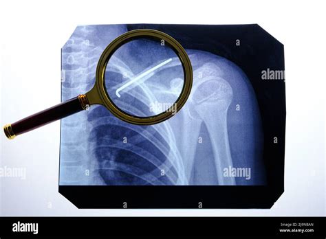 X Ray Broken Collarbone And Spoke Inserted Into It Stock Photo Alamy
