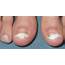 Black Toenail Cancer Things You Must Know  Nedufy