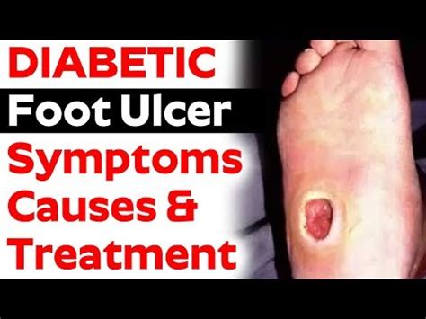 Diabetic Foot Ulcer Symptoms Hot Sex Picture