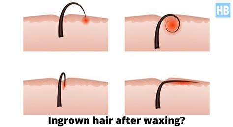 Oh No Bad Ingrown Hairs After Brazilian Wax What To Do