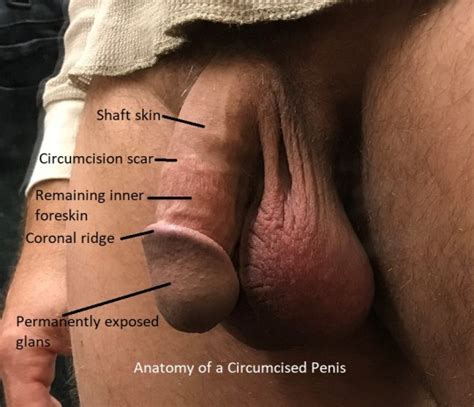 陰茎拡大手術の写真 ナレール