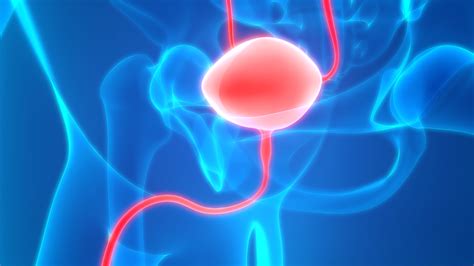 Could you get a second cancer after bladder cancer treatment ? Bladder cancer - Understanding intravesical treatment for ...