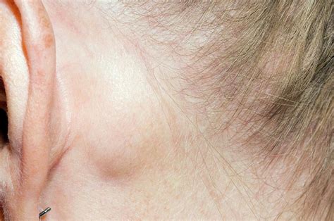 Lump Behind The Ear Causes And When To See A Doctor