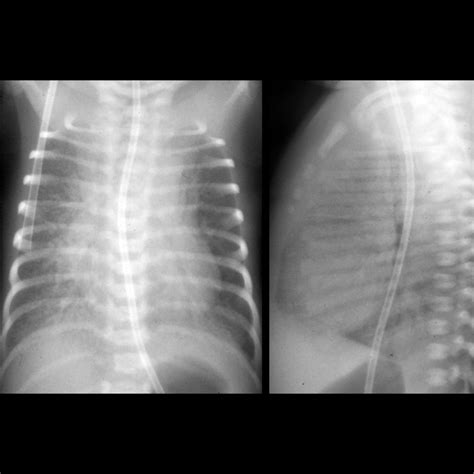 Pulmonary Lymphangiectasia Pediatric Radiology Reference Article