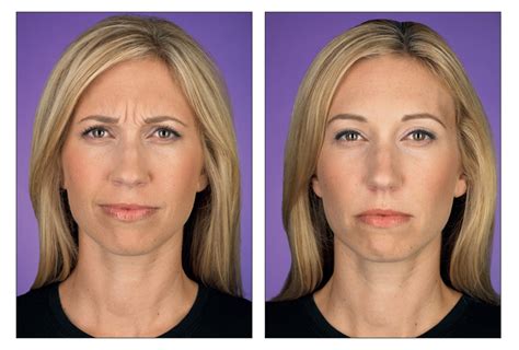 Before And After Botox Pacific Dermatology Center
