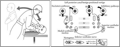 Differentiating Benign Paroxysmal Positional Vertigo From Other Causes