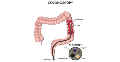 The analysis concluded that undergoing a colonoscopy. Colonoscopy and inflammatory bowel disease | IBDrelief