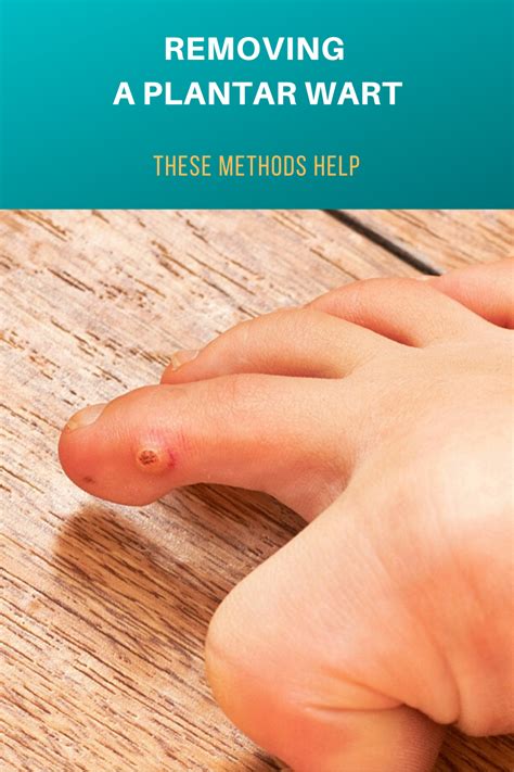 How To Get Rid Of Plantar Warts How To Do Thing